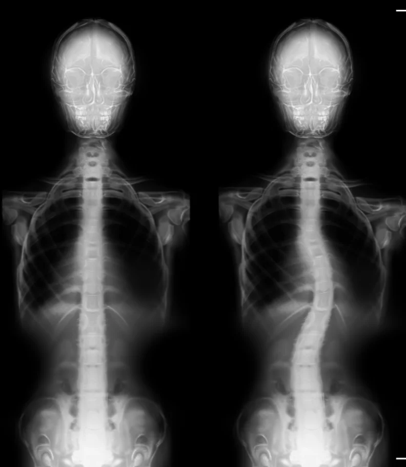 Scoliosis Ellicott City